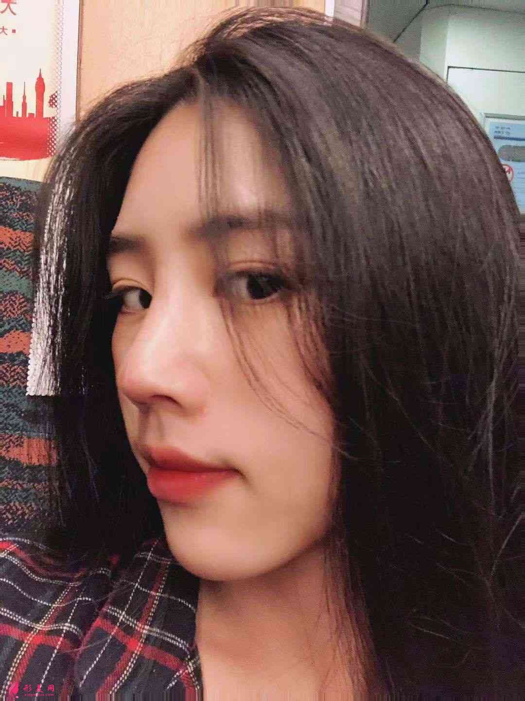 重庆星荣整形外科医院隆鼻怎么样?附隆鼻案例及2021价格表一览