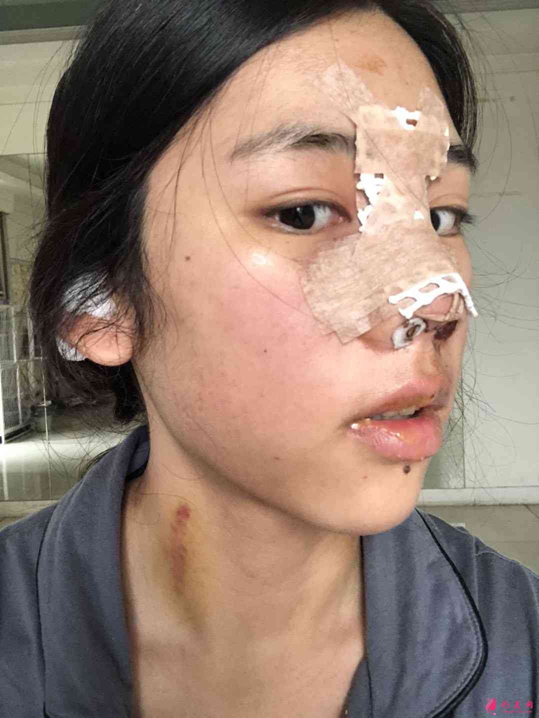 重庆星荣整形外科医院隆鼻怎么样?附隆鼻案例及2021价格表一览