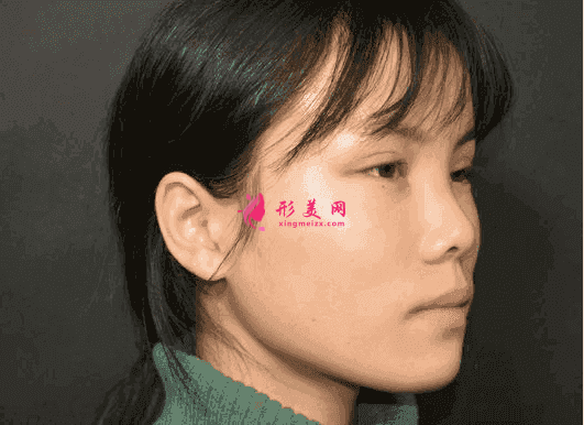 南昌时光整形是三甲医院吗?附玻尿酸隆鼻效果对比及2021价格表发布 南昌时光整形是三甲医院吗?附玻尿酸隆鼻效果对比及2021价格表发布