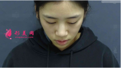 重庆星荣整形外科医院隆鼻怎么样？附隆鼻案例及2021价格表一览