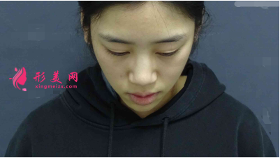 重庆星荣整形外科医院隆鼻怎么样?附隆鼻案例及2021价格表一览