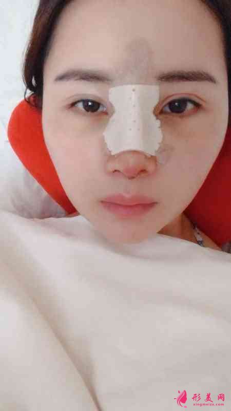 北京壹加壹医院正规吗?附隆鼻案例及2021价格表发布 北京壹加壹医院正规吗?附隆鼻案例及2021价格表发布