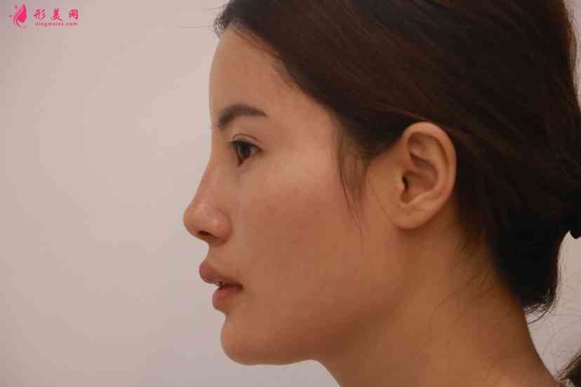 北京壹加壹医院正规吗?附隆鼻案例及2021价格表发布 北京壹加壹医院正规吗?附隆鼻案例及2021价格表发布