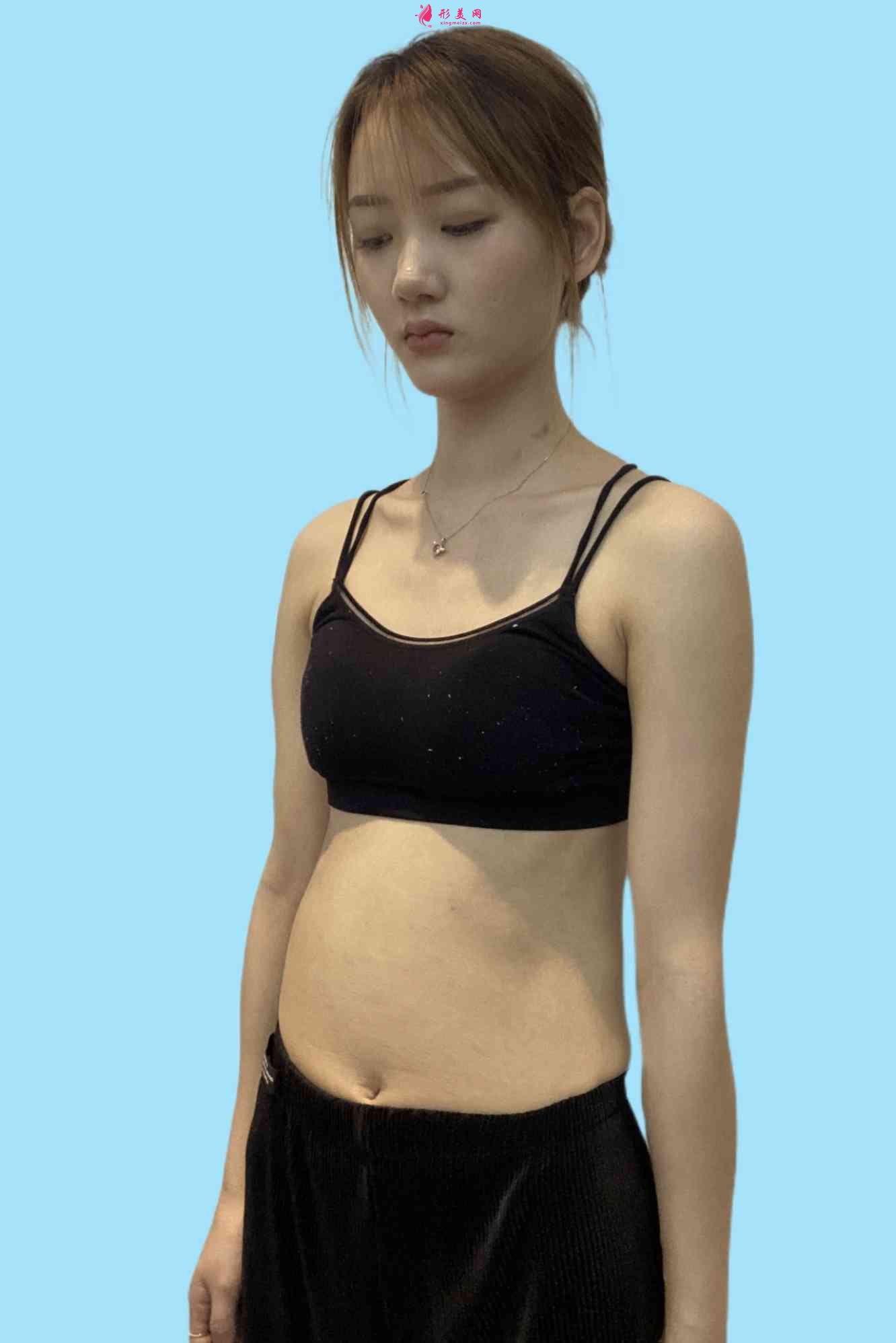 沈阳军区总医院整形科属于公立医院吗?附吸脂案例及2021价格表公开 沈阳军区总医院整形科属于公立医院吗?附吸脂案例及2021价格表公开