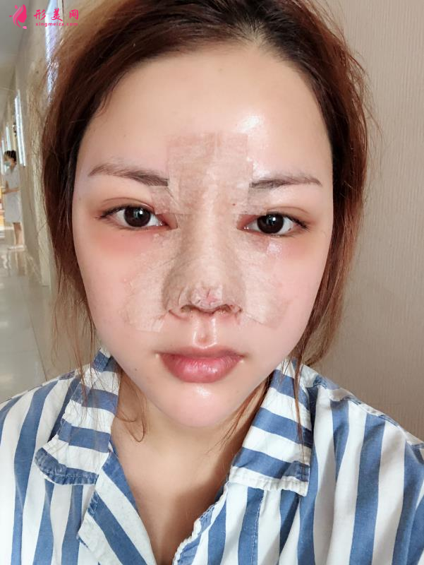 北京八大处隆鼻价格表一览及隆鼻真人案例分享