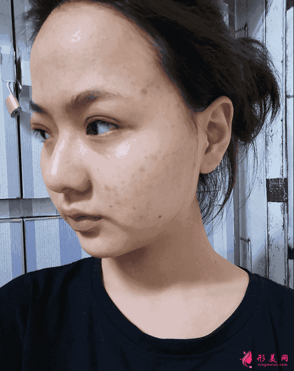 北京三院双眼皮价格？附双眼皮案例及2021价格表公开