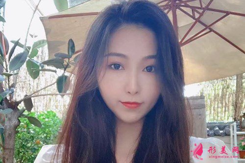 武汉玻尿酸丰下巴手术效果分享