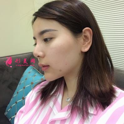 上海长征医院整形科面部吸脂怎么样?术后瘦脸效果跟美颜相机说再见!