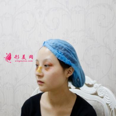 包头一附院整形科怎么样?双眼皮案例实拍对比~术后效果很不一般