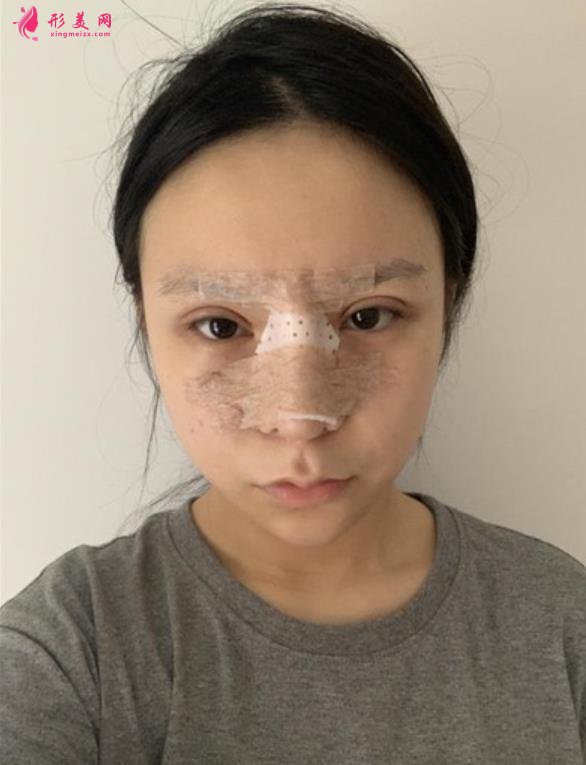 南京友谊医院整形科隆鼻案例术后恢复过程分享！含全新医美价格表