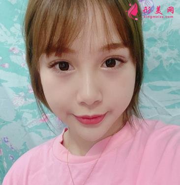 秦皇岛市中医院医学美容科自体脂肪全脸填充案例一览!含全新价格表展示