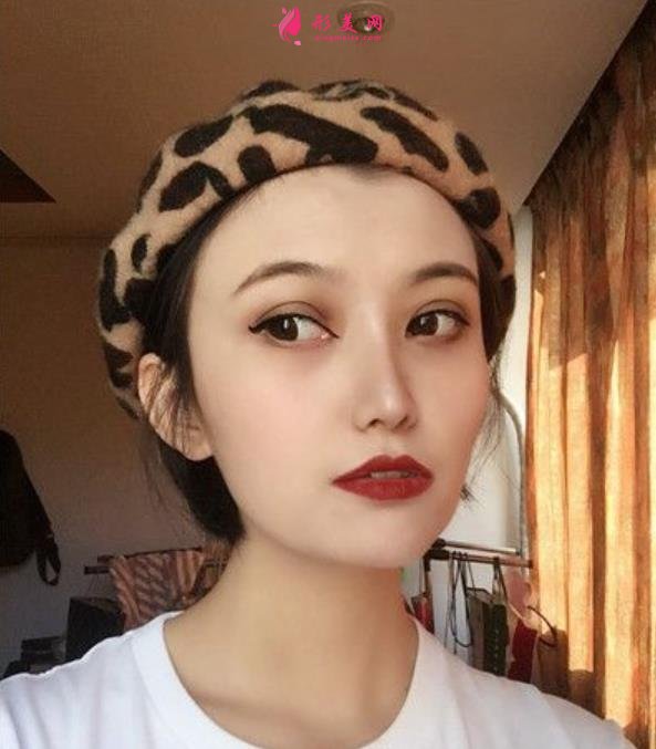 南京医科大整形医院埋线双眼皮好吗?无P图美颜案例在此