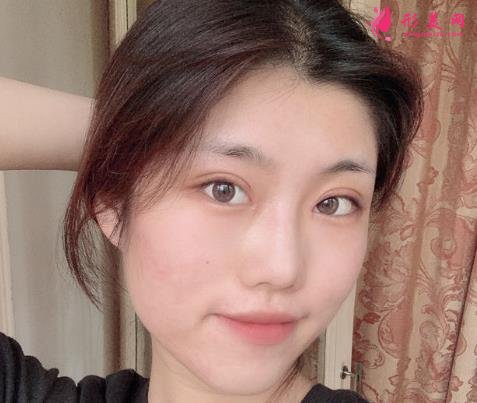 佛山市第一人民医院美容科好吗?双眼皮案例及价格收费表公开对比