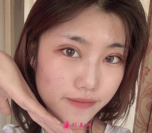 佛山市第一人民医院美容科好吗?双眼皮案例及价格收费表公开对比