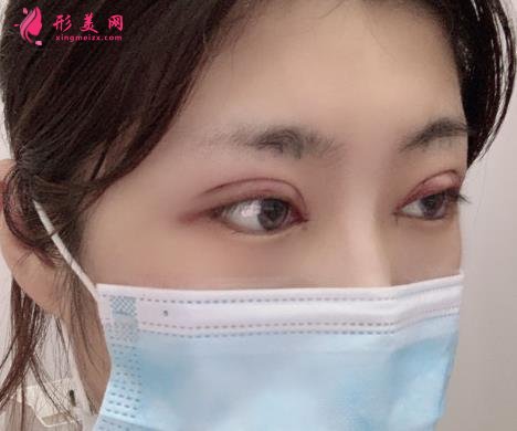 佛山市第一人民医院美容科好吗?双眼皮案例及价格收费表公开对比