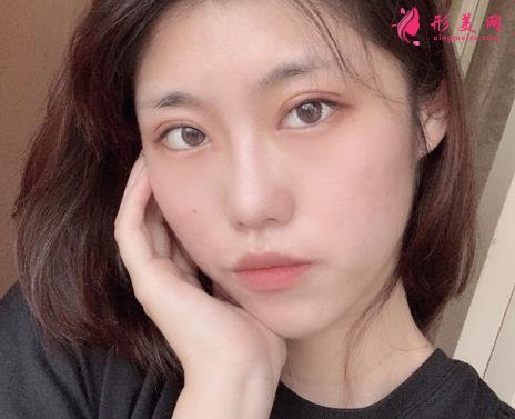 佛山市第一人民医院美容科好吗?双眼皮案例及价格收费表公开对比