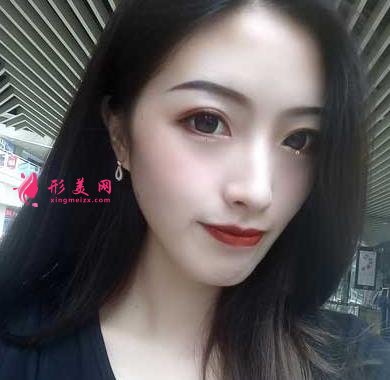 重医附二院整形科怎么样?快来参考埋线双眼皮案例及价格价目表