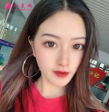重医附二院整形科怎么样?快来参考埋线双眼皮案例及价格价目表