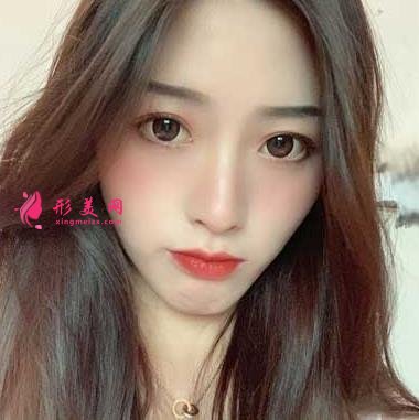 重医附二院整形科怎么样?快来参考埋线双眼皮案例及价格价目表