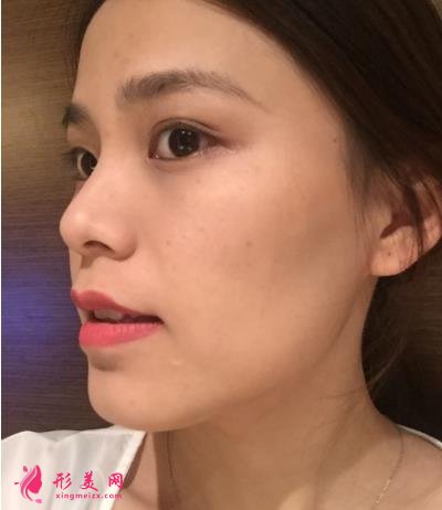 福州海峡美容医院去眼袋怎么样?技术特色、案例、价格收费双双公开