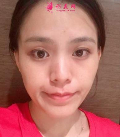 福州海峡美容医院去眼袋怎么样?技术特色、案例、价格收费双双公开