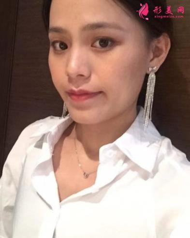 福州海峡美容医院去眼袋怎么样?技术特色、案例、价格收费双双公开