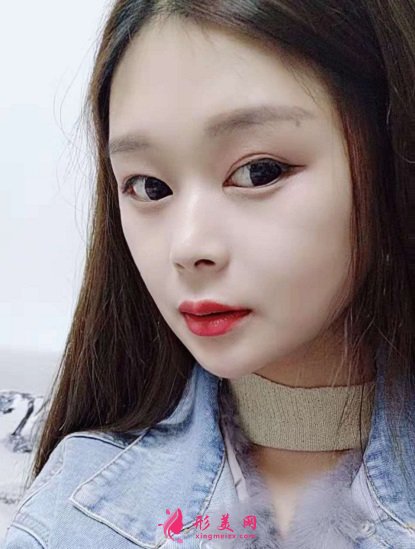 谁让穆宝安做过面部拉皮提升的?分享下北京加减美手术案例及价目表2021