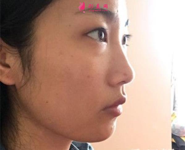 贵州省人民医院瘦脸针价格公示,医美老司机吐血分享,全是干货