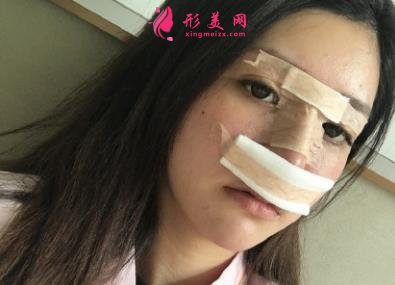 郑大一附院整形科做鼻子怎么样?医生案例及价格价目表公开反馈