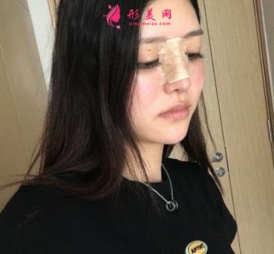 郑大一附院整形科做鼻子怎么样?医生案例及价格价目表公开反馈