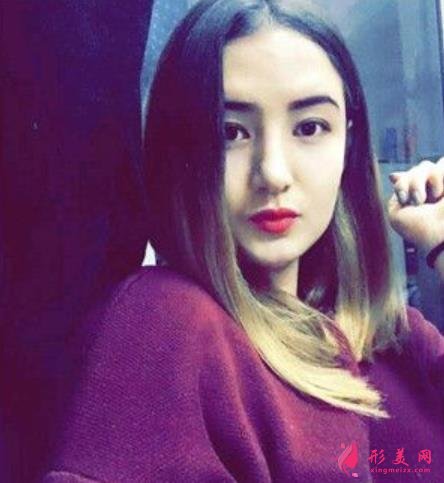 河南整形医院鼻综合恢复过程分享,不化妆无美颜不修图的案例在此