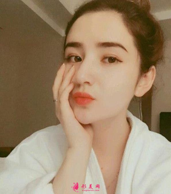 河南整形医院鼻综合恢复过程分享,不化妆无美颜不修图的案例在此