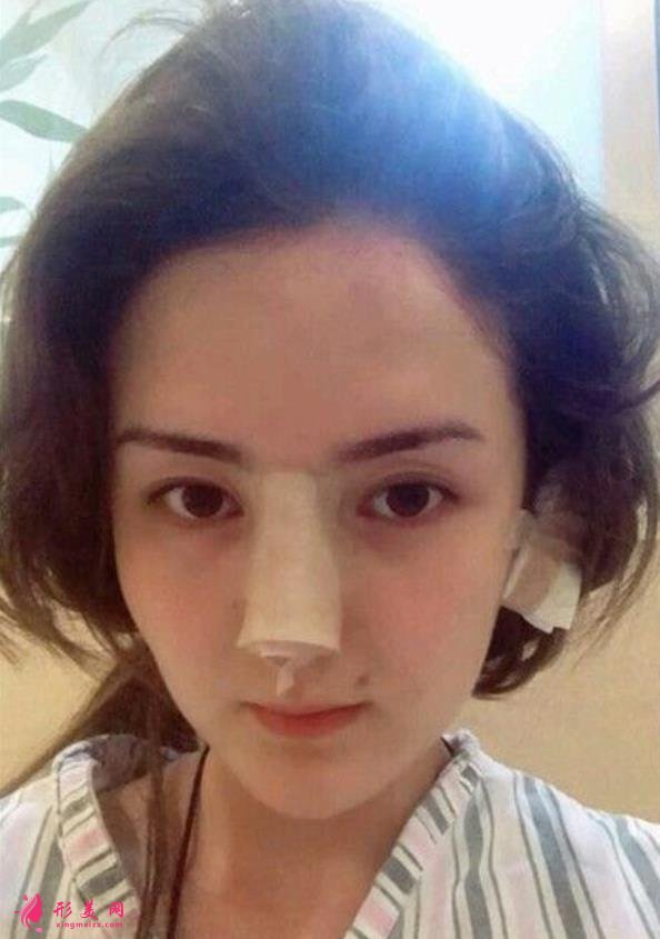 河南整形医院鼻综合恢复过程分享,不化妆无美颜不修图的案例在此