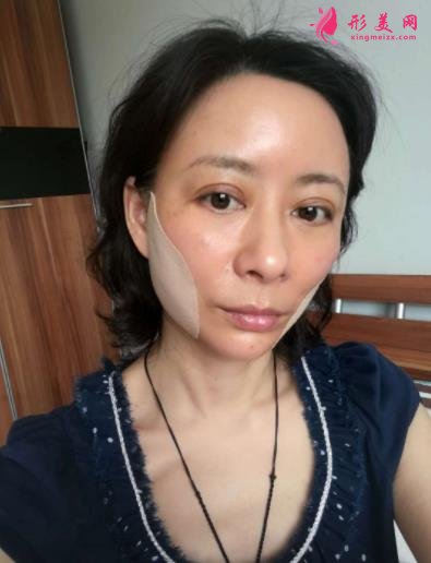 北京瑞丽冯立哲多维拉面部提升怎么样?案例及效果图公开查询