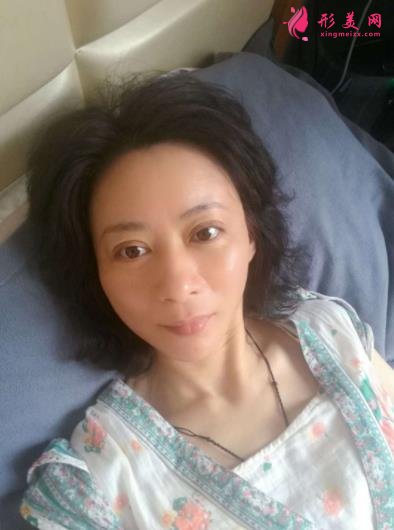 北京瑞丽冯立哲多维拉面部提升怎么样?案例及效果图公开查询