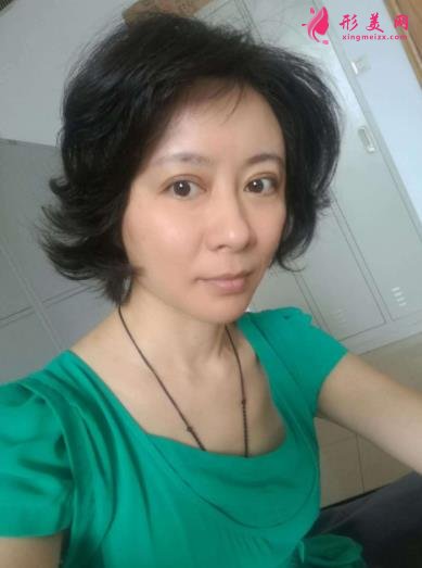 北京瑞丽冯立哲多维拉面部提升怎么样?案例及效果图公开查询