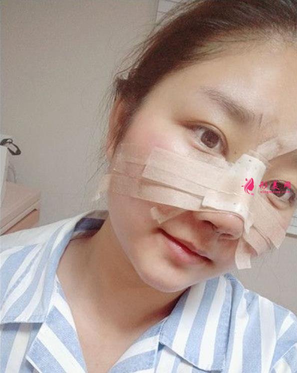 滁州鼓楼医院鼻综合怎么样?术后效果隆鼻的整形医生笑哭了!