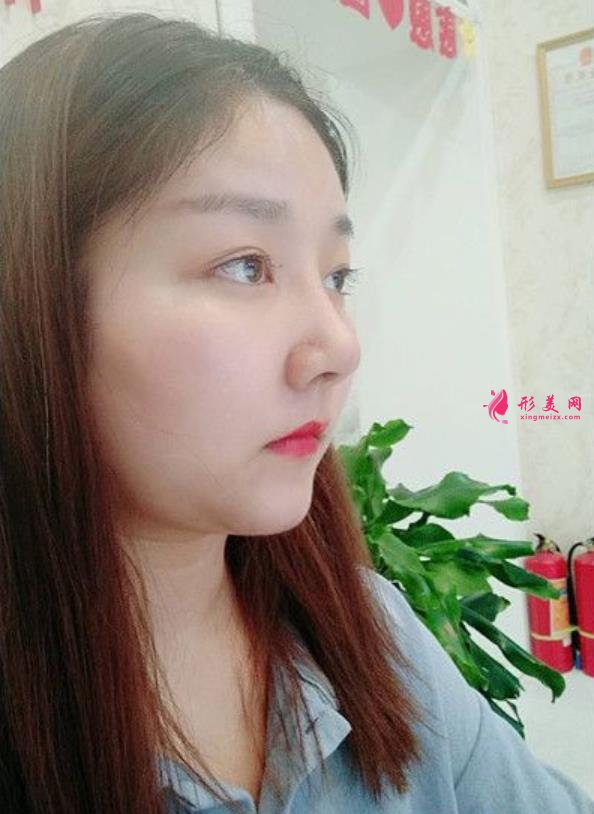 滁州鼓楼医院鼻综合怎么样?术后效果隆鼻的整形医生笑哭了!