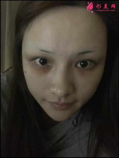 宁波壹加壹整形医院怎么样?从简介及激光去眼袋案例、价格收费可以看出