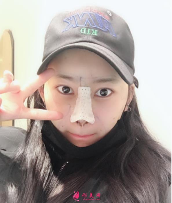 康华医院鼻综合多少钱?花五万做隆鼻!整形医生笑哭了