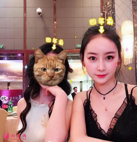 康华医院鼻综合多少钱?花五万做隆鼻!整形医生笑哭了