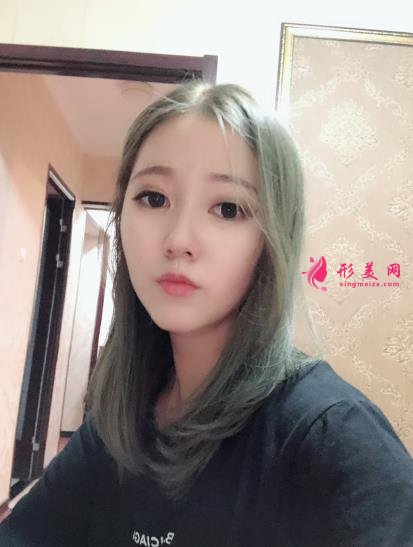 濮阳市人民医院整形科价格价目表收费公开!隆鼻案例对比反馈~