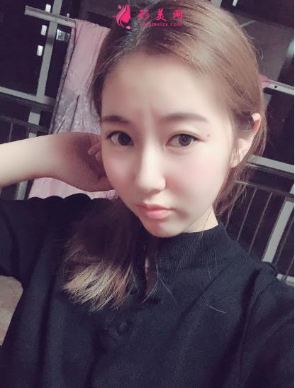 濮阳市人民医院整形科价格价目表收费公开!隆鼻案例对比反馈~