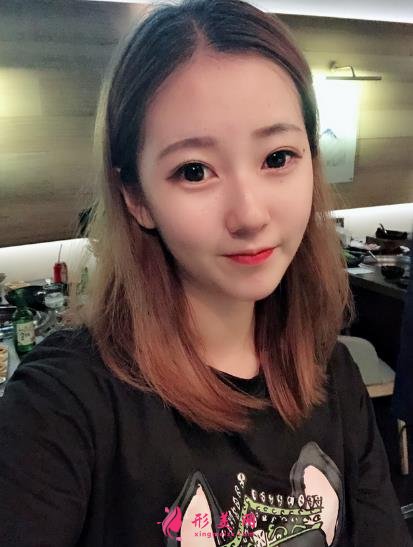 濮阳市人民医院整形科价格价目表收费公开!隆鼻案例对比反馈~