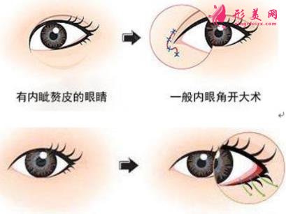 徐州医院双眼皮做得好吗?案例效果分享_眼部修复干货盘点