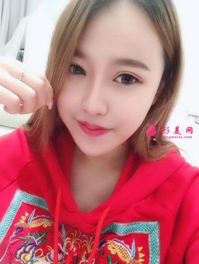 徐州医院双眼皮做得好吗?案例效果分享_眼部修复干货盘点