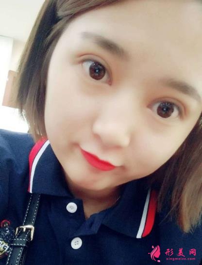 青岛市立医院双眼皮手术怎么样?附手术后注意事项盘点