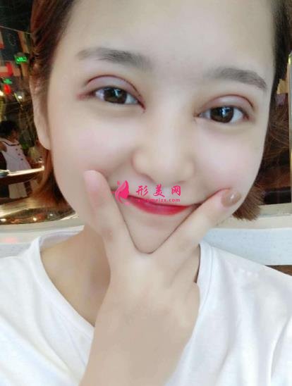 青岛市立医院双眼皮手术怎么样?附手术后注意事项盘点