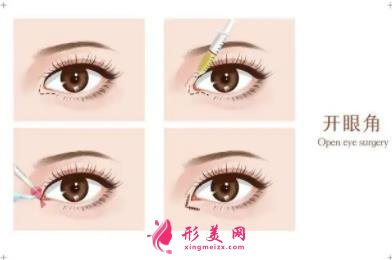 青岛市立医院双眼皮手术怎么样?附手术后注意事项盘点