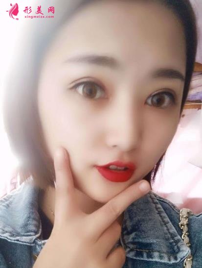 青岛市立医院双眼皮手术怎么样?附手术后注意事项盘点